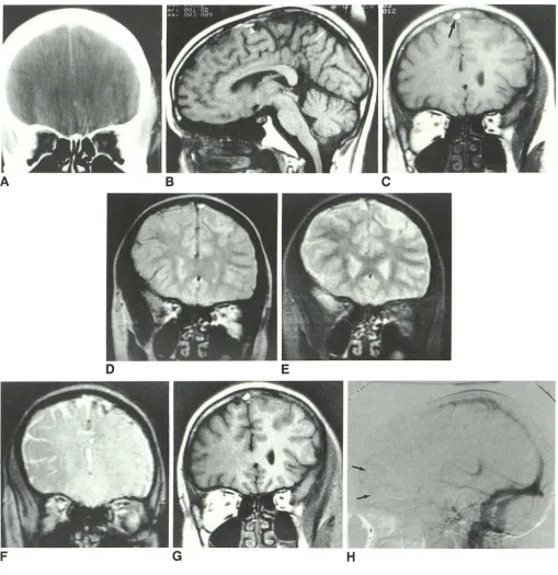 Fig. 1.-Case A, 3: 17-year-old girl with leukemia, on L-asparaginase, presenting with multiple seizures