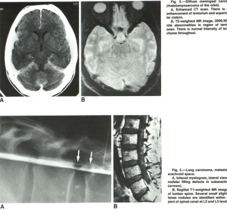 Fig. 2.-Diffuse (rhabdomyosarcoma meningeal carcinomatosis of the orbit). 
