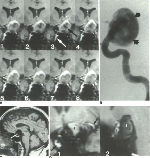 Fig. 1.-54-year-old 5 mm anteriorly arrow) can be earliest obtained 2 flow high playback 5 embolization