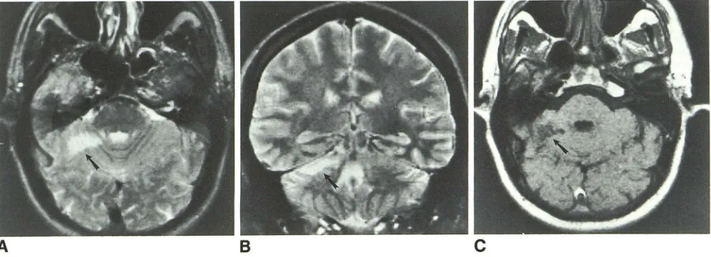 Fig. 4.-39-year-old (arrow, diagnosed A C, man who had several episodes of severe headache associated with right-sided weakness, ataxia, and slurred speech