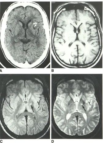 Fig. 1.-A, left CT scan shows low-density lesion putamen (arrow). 