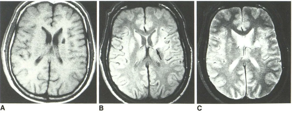 Fig. 2.-74-year-old not signal intensity. Failure A, 8 and man with right-sided face, arm, and leg numbness