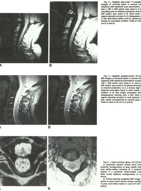 Fig, 3,-Sagittal A, cm inantly obtained with identical scan parameters encoding signal intensity 256 matrix that a 128 x 256 matrix images the spin-echo T1-weighted MR of cervical spine in normal volunteer except was used in A (phase-axis is anterior-poste
