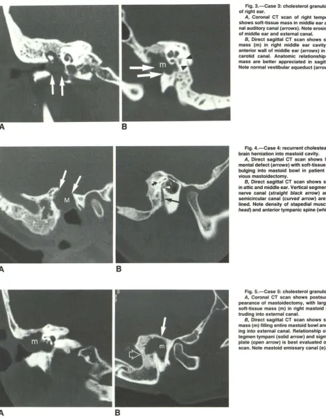 Fig. 3.-Case 3: cholesterol granuloma (cyst) right ear. 