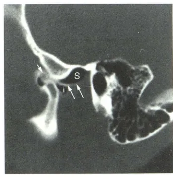 Fig. shows superior semicircular canal. (Compare = receiver coil = (repetition below ment entire spine sity S, Normal 13.-A, Normal facial nerve Direct sagittal CT scan shows mastoid segment of facial nerve canal (open arrow)