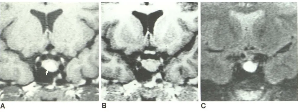 Fig. 1.-Coronal A, images in patient with surgically proved prolactin-secreting microadenoma