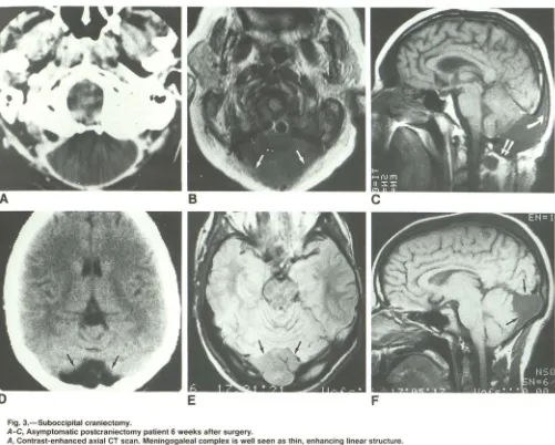 Fig. 3.-Suboccipital A-C, craniectomy. Asymptomatic postcraniectomy patient 6 