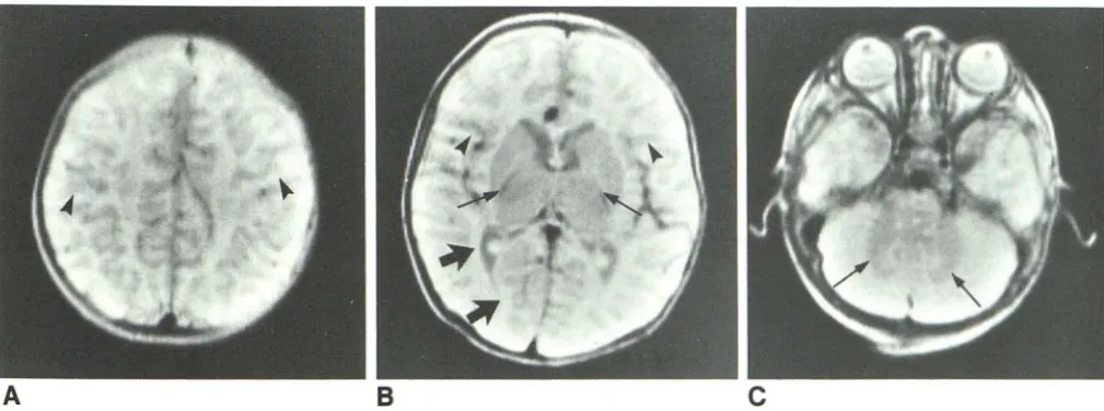 Fig. 2.-lnfantile matter A, 8, C, pattern in 6-day-old boy. Axial MR images (SE 2000/84)