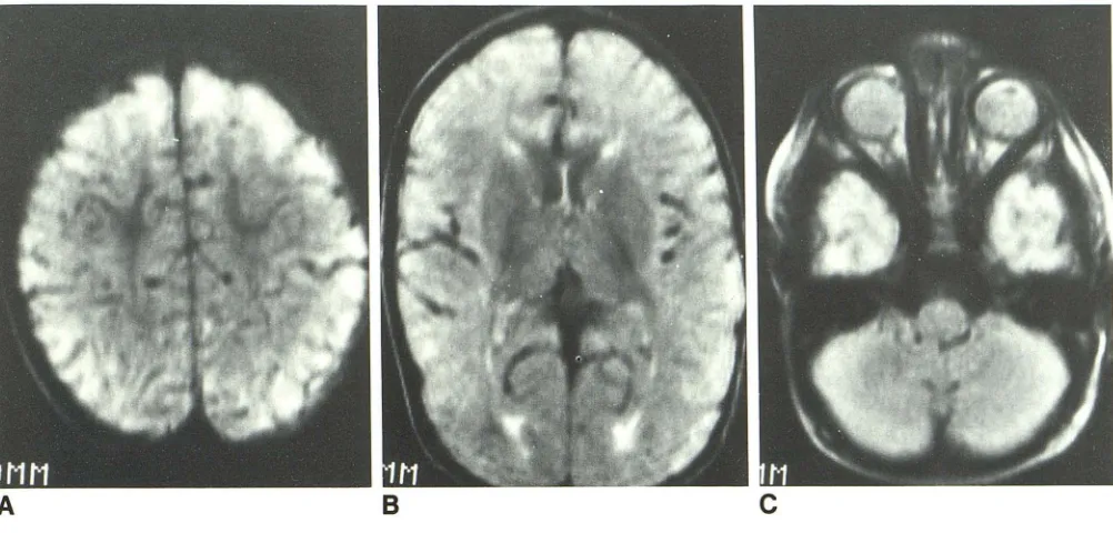Fig. S.-Transition A, C, B, pattern in 11-month-old boy. Axial MR images (SE 2000/84)