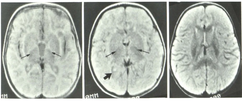 Fig. 12.-Case opmental 2. 18-month-old girl with devel-delay. Isointense pattern with myelination 
