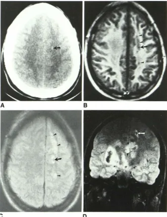 Fig. 2.-19-year-old (arrow) shows deep A, 8-D, man. Axial CT scan 1 day after head trauma very subtle O.S-cm hemorrhagic lesion consistent with diffuse axonal injury in white matter