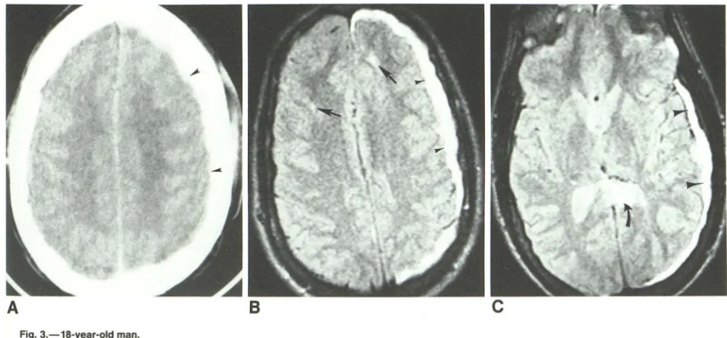 TABLE 3: Sensitivities of CT and MR in the Detection of Cortical Contusions and Diffuse Axonal Injury 