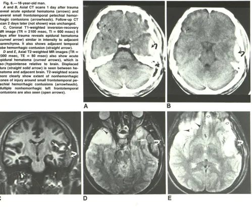 TABLE 4: Relative Sensitivities of CT and MR in the Detection of Primary Brainstem and Subcortical Gray-Matter Lesions 