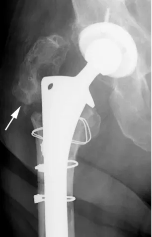 Figure 24 Normal postoperative lateral view of total hip replacement showing measurement of degree of acetabular anteversion.