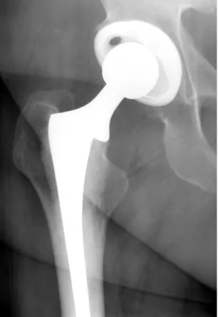 Figure 7 Ceramic femoral head portion of THA. Ceramic head is more radiolucent than remainder of metallic femoral and acetabular components.