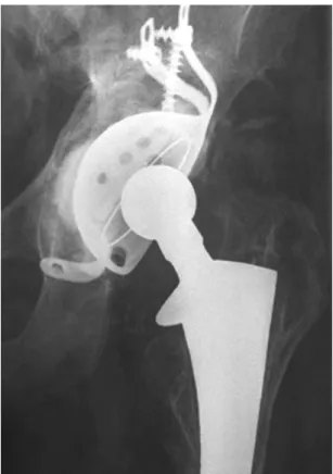 Figure 11 Modular hip prosthesis. Custom length prosthesis re- re-places proximal femur, which was resected for osteosarcoma.
