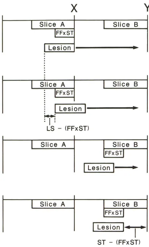 Fig. 1.-Computer Detection then has been moved threshold filling factor not lesion overlaps slice A either slice A equations 4 and 7 in text