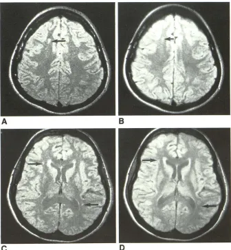Fig. 4.-Comparison of 5- and 10-mm slice thicknesses in patient with multiple sclerosis