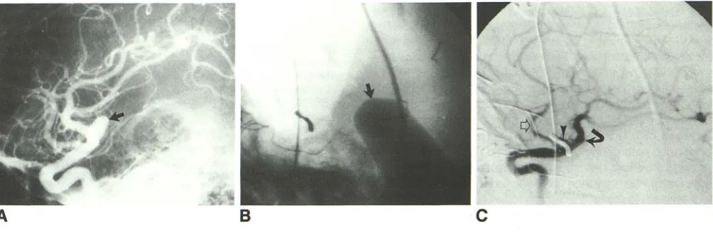 Fig. 1.-A, radiopaque head-B, C, Serial-film postoperative angiogram confirms complete resection Preoperative digital subtraction angiogram, lateral projection, reveals large right frontoparietal arteriovenous malformation (AVM)