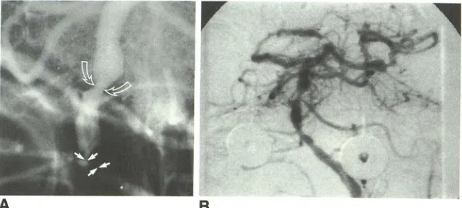 Fig. anterior inferior cerebellar artery. vertebral artery allowed rows) gical exposure to ofemoral approach was unsuccessful