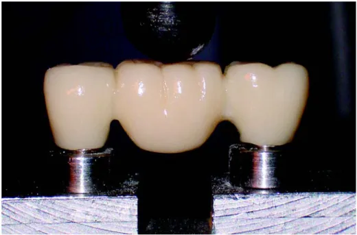 FIGURE 3- Example of a fractured fixed partial denture