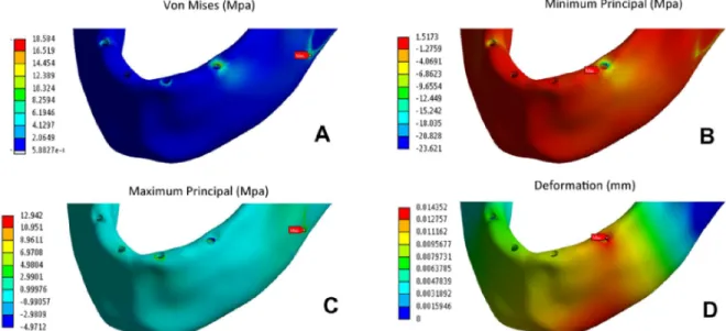 Fig. 4: Values of equivalent stresses, maximum and minimum principal stresses in MPa and deformation in mm for  the cortical bone 