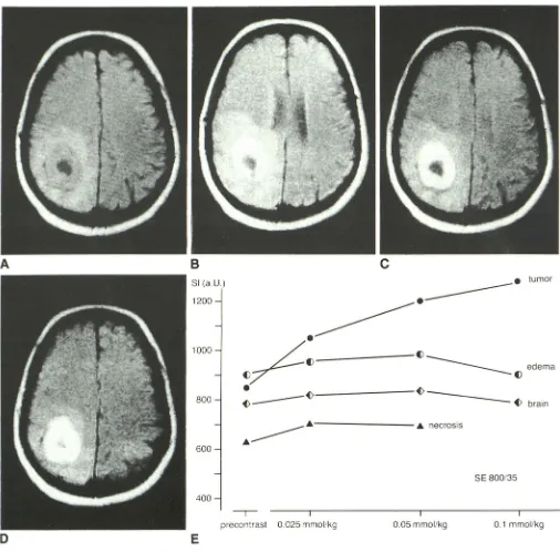 Fig. now poorly defined margin between tumor and E, "necrotic" tissue, edema, and normal brain