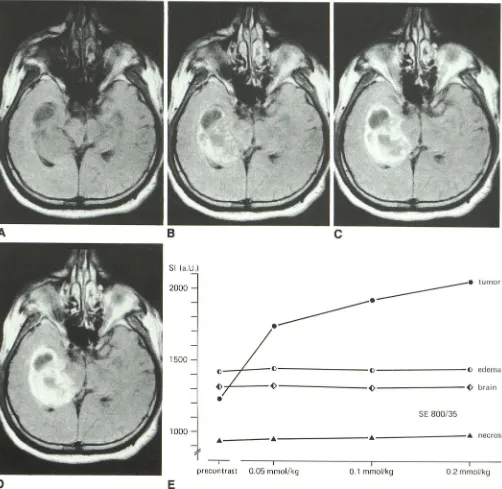 Fig. 5.-Case not obtained in right medial temporal lobe. signal intensity and poorly D, E, B, A, C, 7: 42-year-old man with presumed right temporal glioblastoma