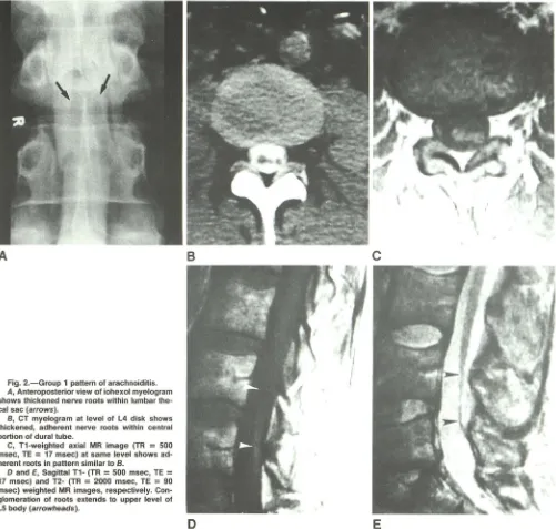 Fig. 2.-Group A, 1 pattern of arachnoiditis. Anteroposterior view of iohexol myelogram 