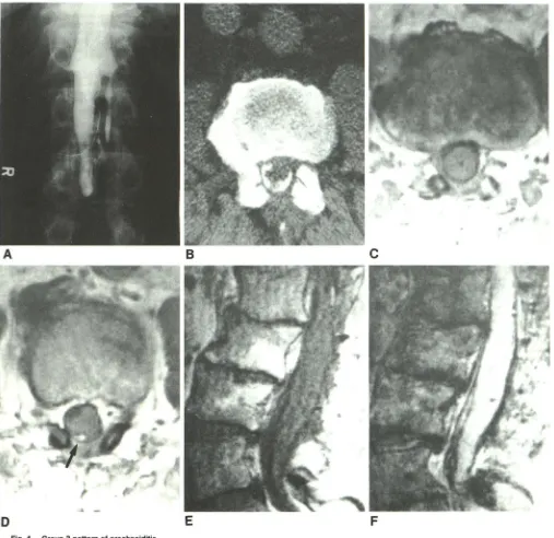 Fig. 4.-Group A, 3 pattern of arachnoiditis. Anteroposterior view of iohexol myelogram via 