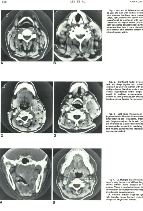 Fig. 3.-Left toid muscle jugular chain in 63-year-old woman with follicular are displaced by large confluent node that extracapsular spread into overlying sternomas-vein small-cleaved-cell lymphoma