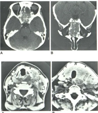 Fig. 7.(arrowheads) -A and 8 , Diffuse thyroid lymphoma of diffuse large-cell subtype with 