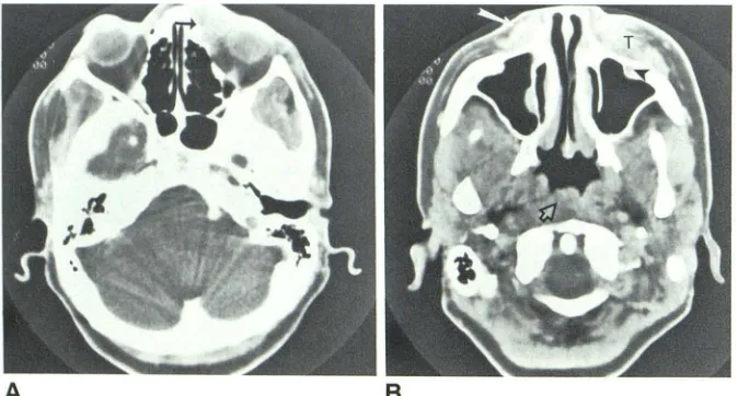Fig. 8.-A head), lesion is (solid cheek diffuse woman. and B, Multicentric involvement of large-cell lymphoma in 36-year-old Note extensive regional infiltration of left lesion (T) into left medial orbital canthus black arrow), left infraorbital canal (arr
