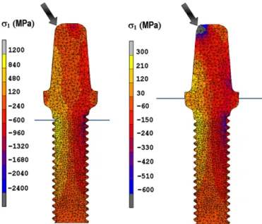 Fig. 11. Stress plots of Zlock3–411 implant in the case of 30° ﬂexion test. Left: 3 mm elevated apex