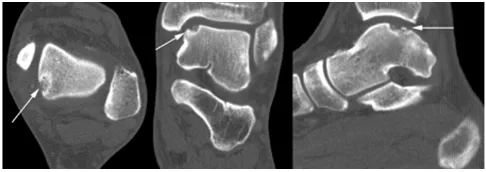 Figure 2talar dome (arrows)typical osteochondral defect located on the posteromedial ittal slices) of the left ankle of a 25-year-old female showing a Preoperative computed tomography (axial, coronal, and sag-Preoperative computed tomography (axial, coronal, and sagittal slices) of the left ankle of a 25-year-old female showing a typical osteochondral defect located on the posteromedial talar dome (arrows).