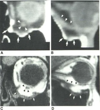 Fig. 3.-Case 3. Blowout fracture of inferior orbital wall without muscle entrapment. Coronal 