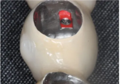 Fig. 2. Internal view of the Marburg double crown with an additional retention element TK-Snap.
