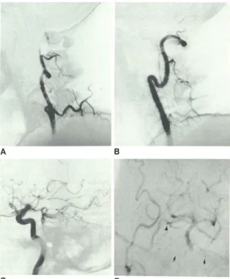 Fig. 5.-STA-SCA SCA ential midbasilar lesion. Right AICA recipient vessel as B, A, bypass for midbasilar stenosis