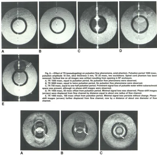 Fig. B.-Effect pulsation amplitude 10 mm, slice thickness 5 mm, of TR (pseudogating) on pulsation flow phenomena, axial phantom