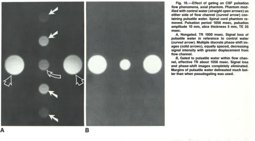 Fig. 10.-Effect of gating on CSF pulsation flow phenomena, axial phantom. Phantom mod-