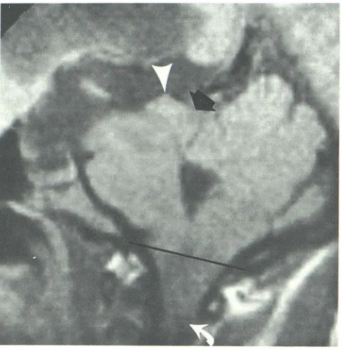 Fig. 4.-Astrocytoma. A, B, SE 1700/40. Coronal section through tectum. Tumor is primarily left-sided but extends across midline (arrows)