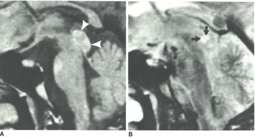 Fig. S.-ProbAqueduct A, B, able neoplasm of tectum (no pathologic diagnosis). Midline sagittal sections