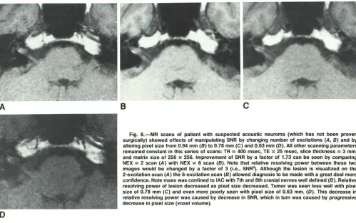 Fig. 8.-MR surgically) scans of patient with suspected acoustic neuroma (which has not been proven showed effects of manipulating SNR by changing number of excitations (A , 8) and by 