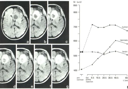 Fig. 2.-injection in 38.5 min p.Recurrent pituitary adenoma (case 11). Series of MR scans before (a), 8.5 min post-injection (p.i.) (b), 18.5 min p.i