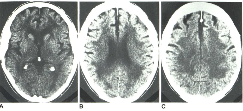 Fig. and Alzheimer's patients by 3.-CT leukoencephalopathy; percent of affected normal individuals two age groups