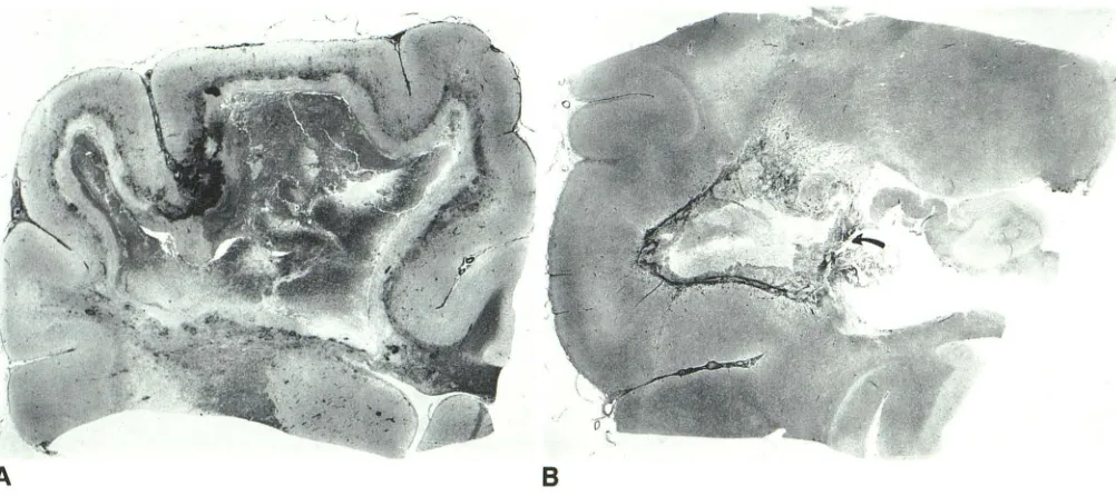 Fig. 1.represent perivascular hemorrhagepextensive inflammatory and sparing of the overlyun-Gross pathologic sections of a staphylococcal abscess 5 days (A) 21 days (8) after inoculation