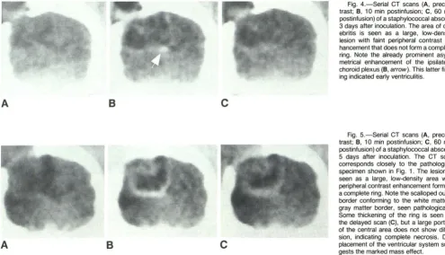 Fig. 4.choroid plexus lesion with faint peripheral contrast hancement that does not form a complete ring