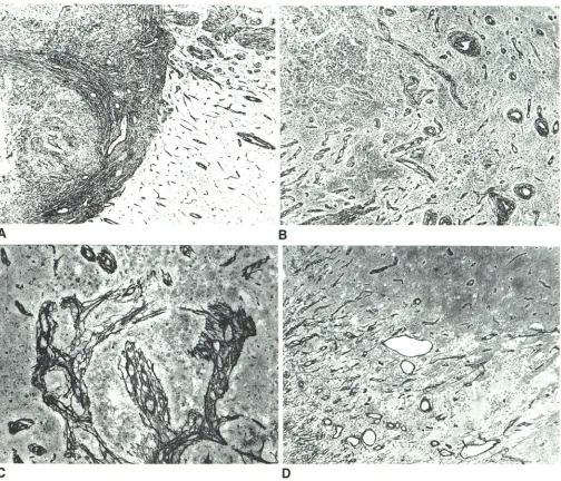 Fig. became evident (8). caabscess shcaabsyet coalesced to form a complete capsule. ular sides of the abscess
