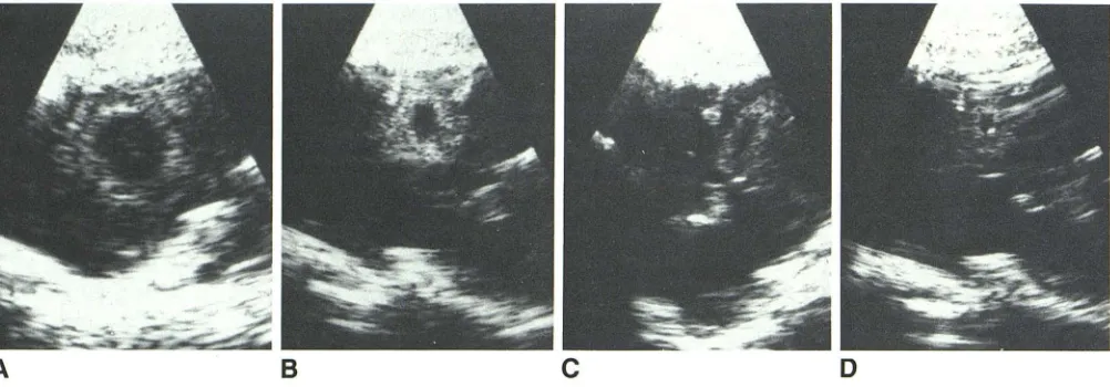 Fig. 7contrastprogressi9 (A).-Postcontrast CT scans (5 min) of a staphylococcal abscess on days , 14 (B), 18 (C), and 21 (0) following inoculation