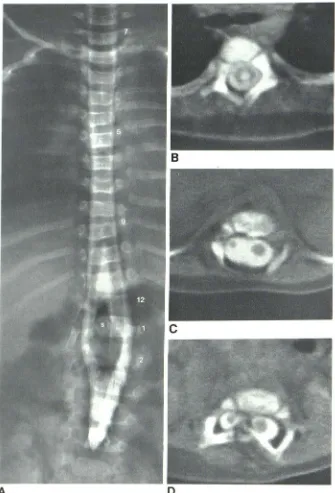 Fig. 1.-Concurrent dromyelia diastematomyelia and hy-in 5-month-old girl with lumbar nevus 